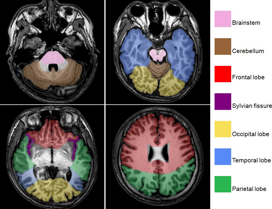 Brain MRI